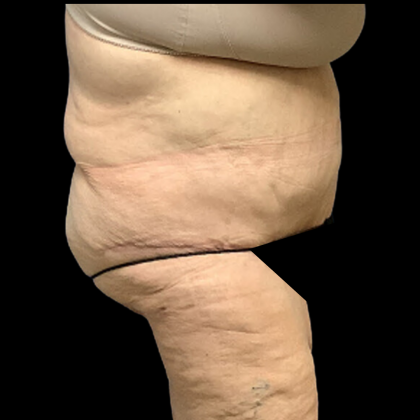Tummy Tuck Before & After Patient #4320
