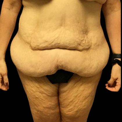 Tummy Tuck Before & After Patient #4323