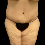 Tummy Tuck Before & After Patient #4323