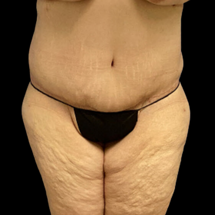 Tummy Tuck Before & After Patient #4323