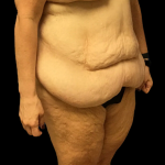 Tummy Tuck Before & After Patient #4323