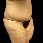 Tummy Tuck Before & After Patient #4323