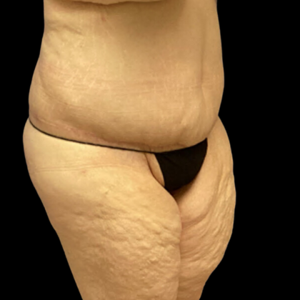 Tummy Tuck Before & After Patient #4323