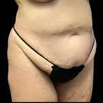 Tummy Tuck Before & After Patient #4319