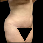 Tummy Tuck Before & After Patient #4319