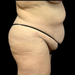 Tummy Tuck Before & After Patient #4319