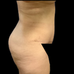 Tummy Tuck Before & After Patient #4319