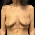Breast Augmentation Before & After Patient #4326