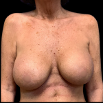 Breast Augmentation Before & After Patient #4326