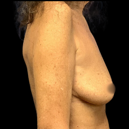 Breast Augmentation Before & After Patient #4326