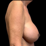 Breast Augmentation Before & After Patient #4326