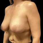 Tummy Tuck Before & After Patient #4327