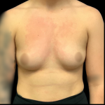 Breast Augmentation Before & After Patient #4329