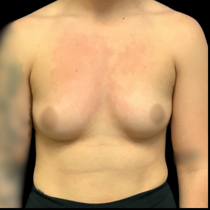 Breast Augmentation Before & After Patient #4329