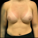 Breast Augmentation Before & After Patient #4329