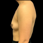 Breast Augmentation Before & After Patient #4329