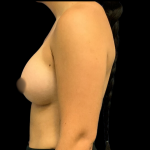 Breast Augmentation Before & After Patient #4329
