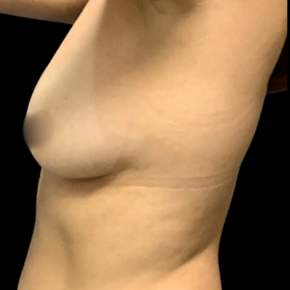 Breast Augmentation Before & After Patient #4331
