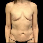 Breast Augmentation Before & After Patient #4332