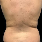 Liposuction Before & After Patient #4452