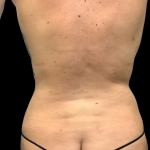 Liposuction Before & After Patient #4452
