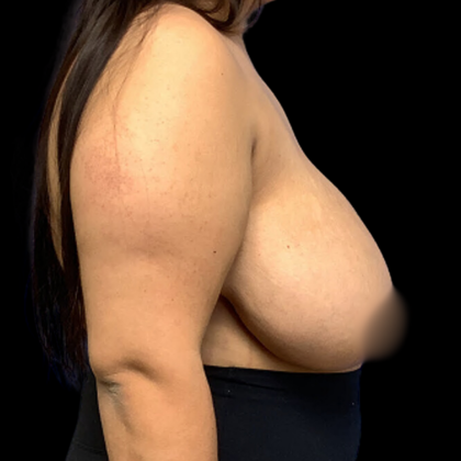 Breast Reduction Before & After Patient #4333
