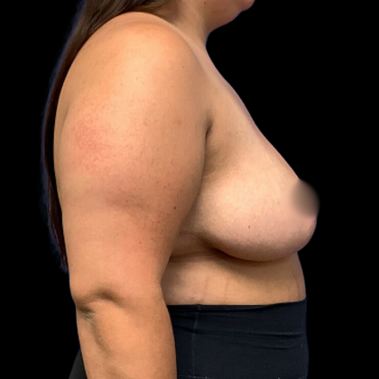 Breast Reduction Before & After Patient #4333
