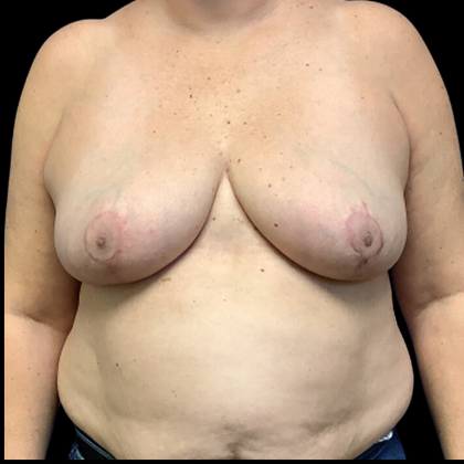 Breast Reduction Before & After Patient #4334