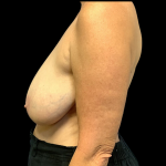 Breast Reduction Before & After Patient #4335