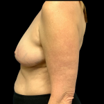 Breast Reduction Before & After Patient #4335