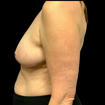 Breast Reduction Before & After Patient #4335
