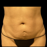 Tummy Tuck Before & After Patient #4645