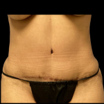 Tummy Tuck Before & After Patient #4645