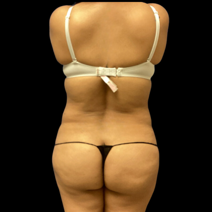 Tummy Tuck Before & After Patient #4645