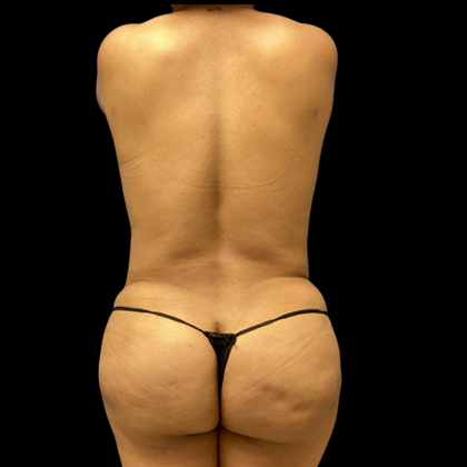 Tummy Tuck Before & After Patient #4645