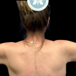 Arm Lift Before & After Patient #4443