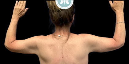Arm Lift Before & After Patient #4443