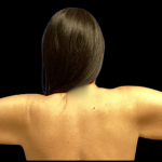 Arm Lift Before & After Patient #4444