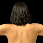 Arm Lift Before & After Patient #4444