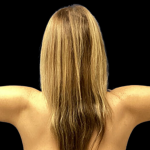 Arm Lift Before & After Patient #4445