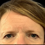 Brow Lift Before & After Patient #4446