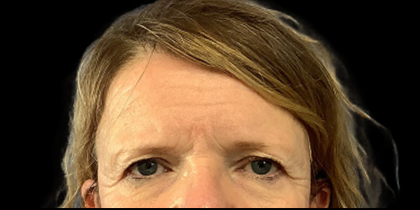 Brow Lift Before & After Patient #4446