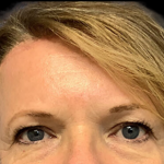 Brow Lift Before & After Patient #4446