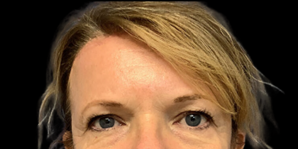 Brow Lift Before & After Patient #4446
