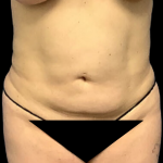Tummy Tuck Before & After Patient #4341