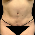 Tummy Tuck Before & After Patient #4341