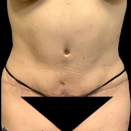 Tummy Tuck Before & After Patient #4341