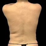 Tummy Tuck Before & After Patient #4341