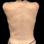Tummy Tuck Before & After Patient #4341