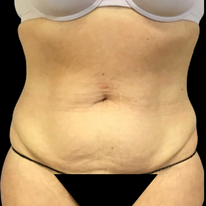 Liposuction Before & After Patient #4646